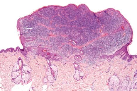 Fig. 29.174, T-cell rich angiomatoid polypoid pseudolymphoma (TRAPP): scanning view of polypoid nodule.