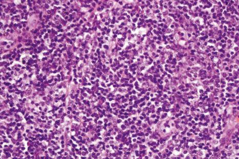 Fig. 29.177, T-cell rich angiomatoid polypoid pseudolymphoma (TRAPP): detailed view of infiltrate.