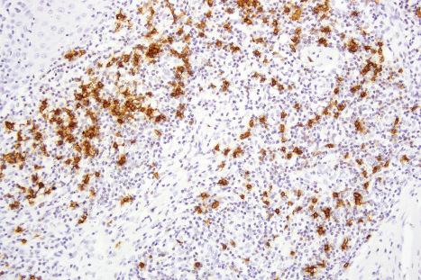 Fig. 29.179, T-cell rich angiomatoid polypoid pseudolymphoma (TRAPP): small numbers of CD20-positive lymphocytes are also seen.