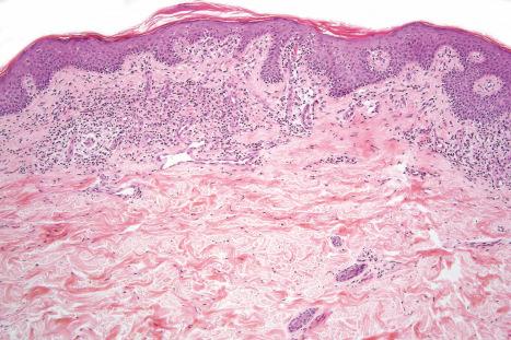 Fig. 29.18, Mycosis fungoides (patch stage): this biopsy of an early lesion shows focal parakeratosis, acanthosis, atypical lymphocytes ‘tagging’ the dermal–epidermal junction and a superficial perivascular lymphohistiocytic infiltrate.