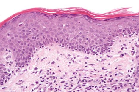 Fig. 29.19, Mycosis fungoides (patch stage): high-power view of atypical lymphocytes tagging the dermal–epidermal junction.