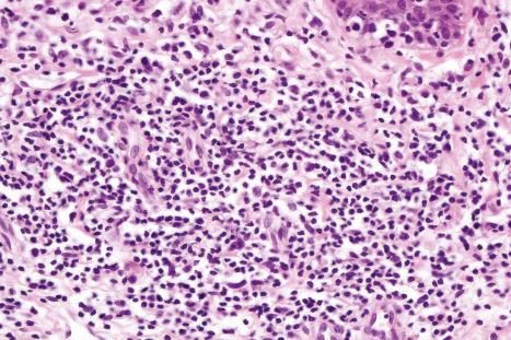 Fig. 29.20, Mycosis fungoides (patch stage): there is a superficial perivascular lymphohistiocytic infiltrate. Atypical cells are not seen.