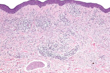 Fig. 29.23, Mycosis fungoides: the case illustrated here and in Figs 29.24–29.26 demonstrates the effects of prior treatment with PUVA before biopsy. Note the dermal perivascular and interstitial lymphocytic infiltrate.