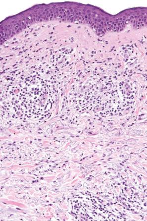 Fig. 29.24, Mycosis fungoides: higher-power view of Fig. 29.23 .