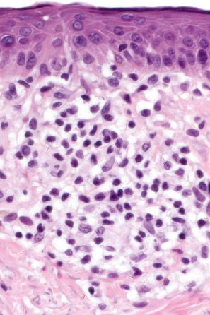 Fig. 29.25, Mycosis fungoides: mild cytological atypia is evident.