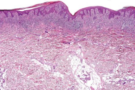 Fig. 29.27, Mycosis fungoides (plaque stage): there is focal parakeratosis and marked psoriasiform hyperplasia.