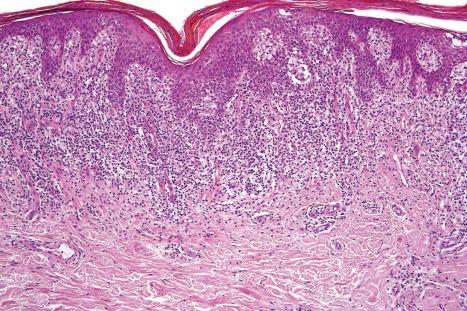 Fig. 29.28, Mycosis fungoides (plaque stage): there is a dense upper dermal bandlike infiltrate.