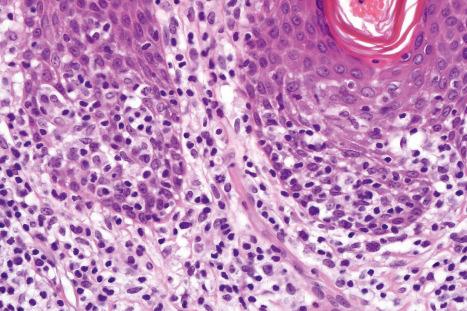 Fig. 29.29, Mycosis fungoides (plaque stage): there is a dense population of atypical lymphocytes with marked epidermotropism.