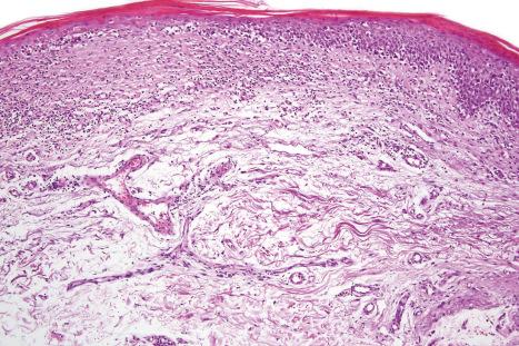 Fig. 29.30, Mycosis fungoides (poikiloderma atrophicans vasculare): there is hyperkeratosis, epidermal atrophy, marked basal cell hydropic degeneration, and fibrosis.