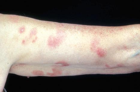 Fig. 29.3, Mycosis fungoides: multiple patches are present on this patient's arm.