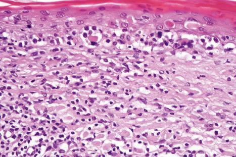 Fig. 29.31, Mycosis fungoides (poikiloderma atrophicans vasculare): there is liquefactive degeneration of the basal layer, and cytoid bodies are present. Note the scattered intraepidermal atypical lymphocytes.