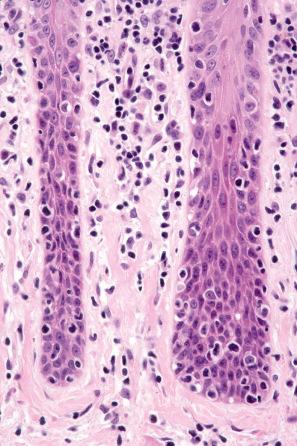 Fig. 29.32, Mycosis fungoides (plaque stage): note the vertically orientated fibrous tissue. This results from chronic scratching.