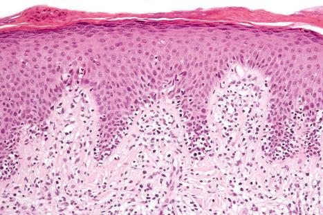 Fig. 29.33, Mycosis fungoides (plaque stage): in this example, the scarring is more marked.