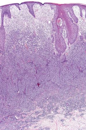 Fig. 29.34, Mycosis fungoides (tumor stage): an intense infiltrate is present in the dermis.