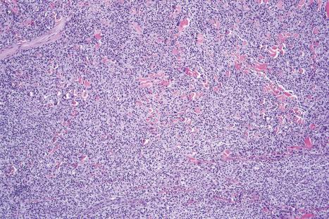 Fig. 29.35, Mycosis fungoides (tumor stage): note the dissection of collagen.