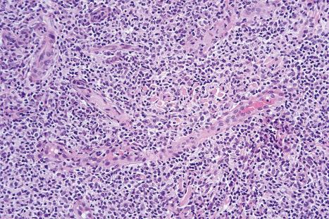 Fig. 29.37, Mycosis fungoides (tumor stage): this view demonstrates the conspicuous vasculature.