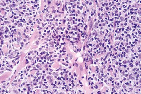 Fig. 29.38, Mycosis fungoides (tumor stage): high-power view.