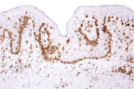 Fig. 29.39, Mycosis fungoides: intraepidermal lymphocytes are highlighted with CD3 immunohistochemistry. Note the conspicuous tagging.