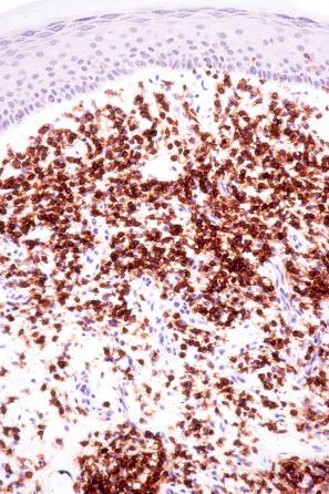 Fig. 29.40, Mycosis fungoides: the lymphocytes express CD4.