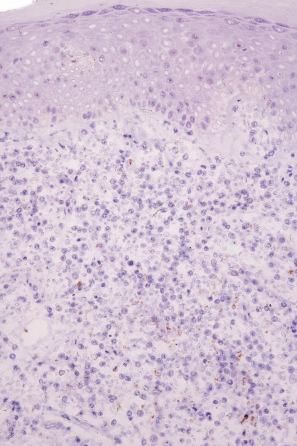 Fig. 29.41, Mycosis fungoides: CD7 is absent.