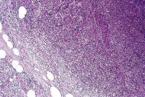 Fig. 29.42, Mycosis fungoides: this lymph node biopsy shows partial replacement by mycosis cells. Note the spillover into the pericapsular fat.