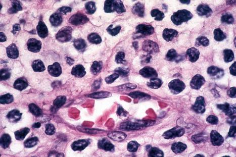 Fig. 29.44, Mycosis fungoides: mycosis cells surround a postcapillary venule.