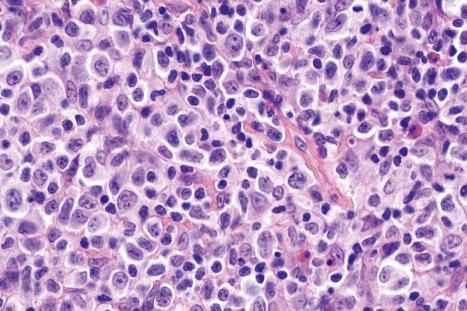 Fig. 29.46, Mycosis fungoides (transformation): the infiltrate is composed predominantly of blast cells with large vesicular nuclei and prominent nucleoli.