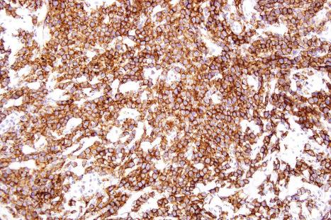 Fig. 29.49, Mycosis fungoides (transformation): the tumor cells express CD30.