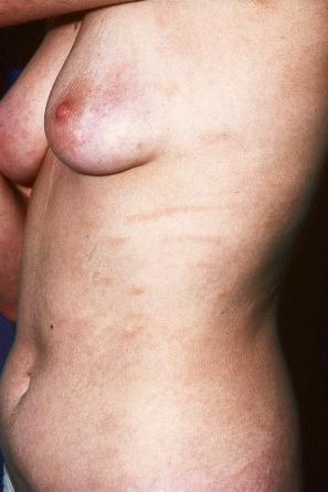 Fig. 29.5, Superficial scaly dermatitis: this patient shows digitate erythematous lesions in a characteristic distribution.