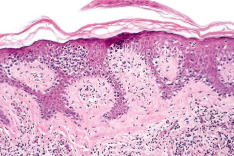 Fig. 29.51, Childhood mycosis fungoides: there is parakeratosis, psoriasiform hyperplasia, and an atypical lymphoid infiltrate.