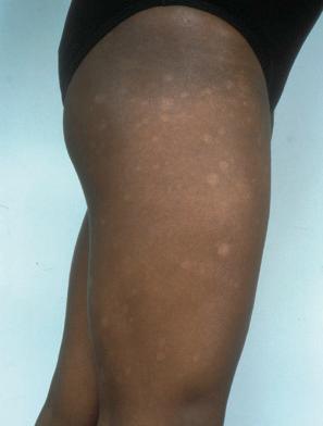 Fig. 29.52, Hypopigmented mycosis fungoides: this variant predominantly affects dark-skinned races.