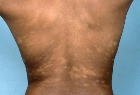 Fig. 29.53, Hypopigmented mycosis fungoides: patches of variable sizes, some of which appear infiltrated.