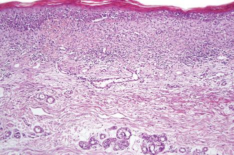 Fig. 29.56, Purpuric mycosis fungoides: this specimen comes from a patient with poikiloderma atrophicans vasculare.