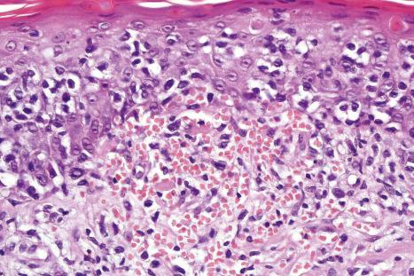 Fig. 29.57, Purpuric mycosis fungoides: high-power view showing red cell extravasation.