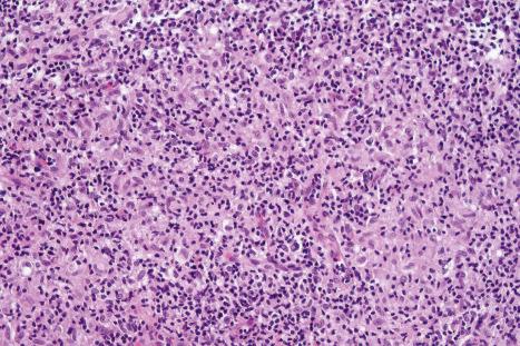 Fig. 29.59, Granulomatous mycosis fungoides: in this field there is a well-developed granulomatous inflammatory infiltrate with a background of atypical lymphocytes.