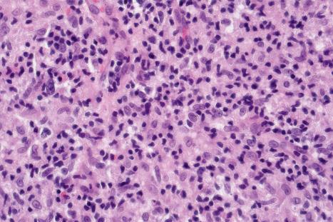 Fig. 29.60, Granulomatous mycosis fungoides: high-power view.