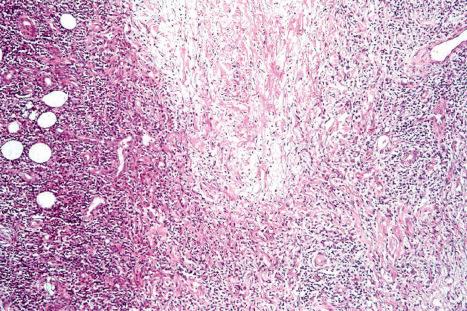 Fig. 29.62, Granulomatous mycosis fungoides: this case shows necrobiosis-like features. The collagen fibers are swollen and eosinophilic.