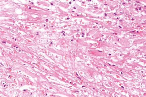 Fig. 29.63, Granulomatous mycosis fungoides: close-up view of necrobiosis.