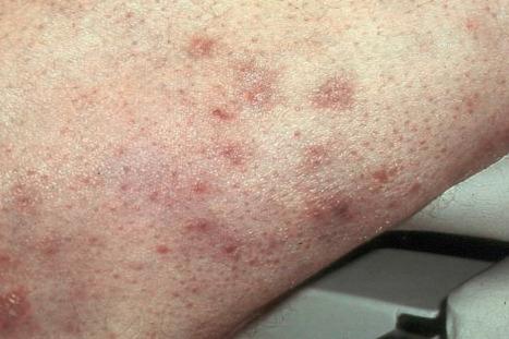 Fig. 29.64, Syringotropic mycosis fungoides: distinct papules are present on this patient's arm.