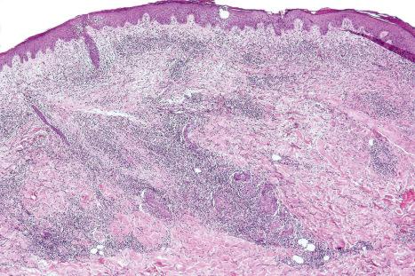 Fig. 29.65, Syringotropic mycosis fungoides: low-power view showing a distinctly nodular lymphoid infiltrate.