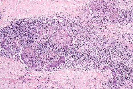 Fig. 29.66, Syringotropic mycosis fungoides: the infiltrate is centered on hyperplastic sweat glands.