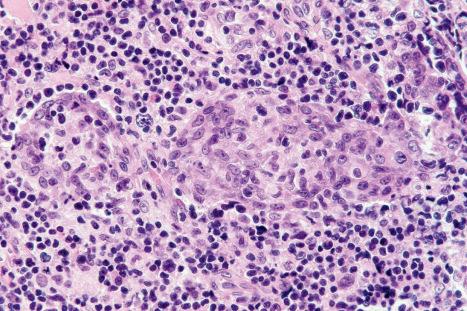 Fig. 29.67, Syringotropic mycosis fungoides: the lymphocytes have infiltrated the sweat gland epithelium.