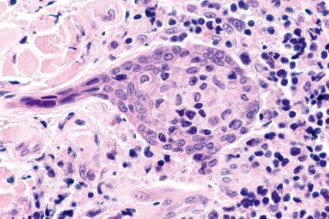 Fig. 29.68, Syringotropic mycosis fungoides: in this field, there is marked hyperplasia of the sweat gland epithelium.