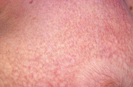 Fig. 29.7, Mycosis fungoides (poikiloderma atrophicans vasculare): this field shows the typical features of reticulate pigmentation, atrophy, scaling, and telangiectasia.