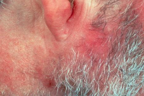 Fig. 29.71, Folliculotropic mycosis fungoides: erythematous lesions are present in the beard area and on the neck. The patient had associated mycosis fungoides.