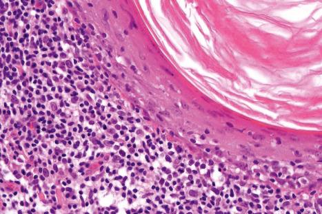 Fig. 29.75, Folliculotropic mycosis fungoides: note the atypical lymphocytes investing the follicle.