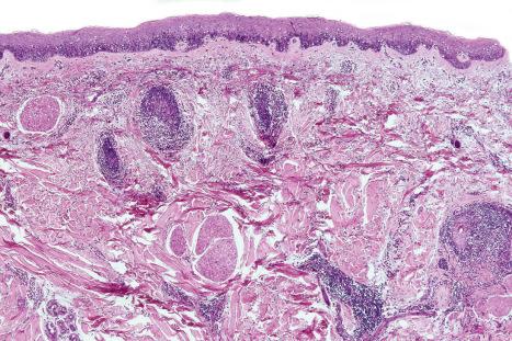 Fig. 29.76, Folliculotropic mycosis fungoides: this specimen comes from the leg. The follicles are ensheathed by an atypical lymphoid infiltrate.