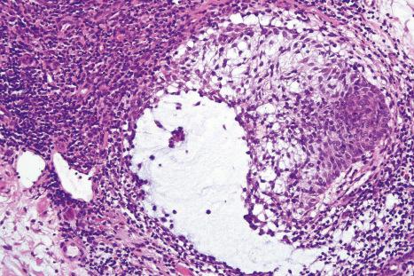 Fig. 29.79, Folliculotropic mycosis fungoides: there is striking follicular mucinosis.