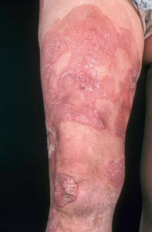 Fig. 29.8, Mycosis fungoides: large erythematous plaques with scaling.