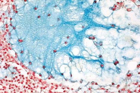 Fig. 29.81, Folliculotropic mycosis fungoides: the mucin stains positively with Alcian blue at pH 2.5.